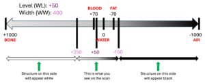 The Hounsfield Unit, Window Level & Width – 3 AM SCAN